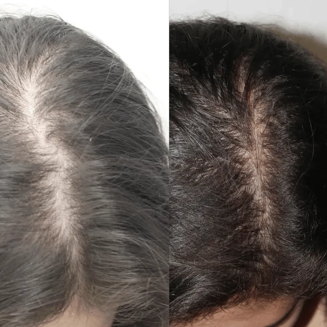 Before-After-Images-Real-Client-Transformations-0-Healthy-Beginnings-Wellness-Esthetics