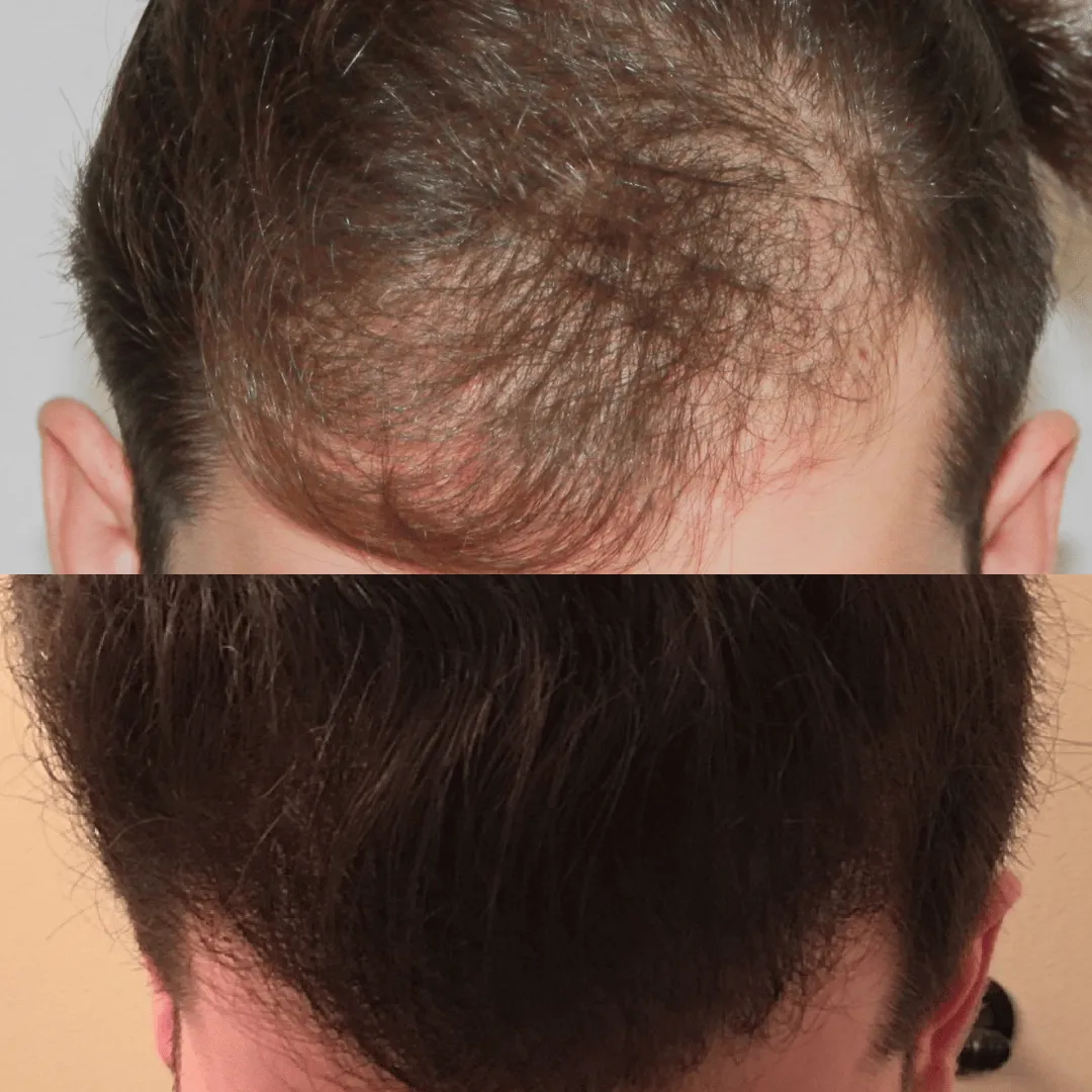 Before-After-Images-Real-Client-Transformations-Healthy-Beginnings-Wellness-Esthetics-0001